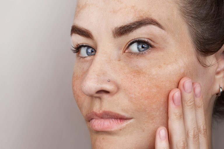 close-up-caucasian-womans-face-with-freckles-age-spots-age-spots-face-woman-with-blue-eyes-looks-camera